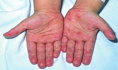 水痘图片初期 水痘的症状和治疗
