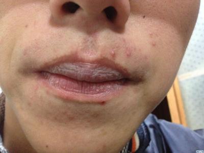 嘴巴周围长痘的原因 嘴巴周围长痘的原因 长痘是如何引起的