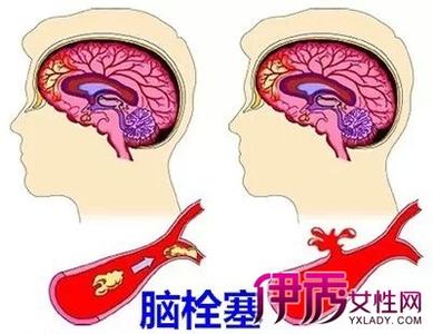 怎样预防脑血栓形成 脑血栓是怎么形成的 预防脑血栓发生