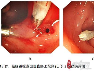 胃穿孔症状 胃穿孔症状 胃穿孔的3个症状