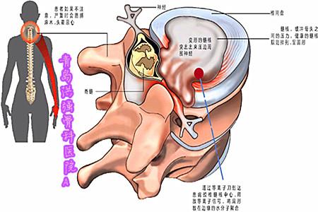 治疗颈椎病有哪些方法 颈椎病的治疗 哪些方法应知晓