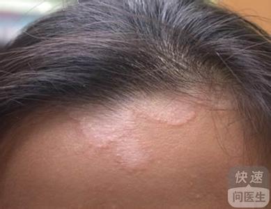 头皮癣症状早期图片 头皮癣怎么治