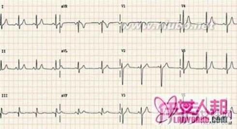常见异常心电图 教你如何分析三大常见异常心电图