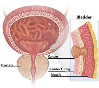 膀胱癌的早期症状 膀胱癌症状 得了膀胱癌该怎么办
