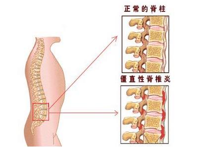 强直性脊柱炎的症状 强直性脊柱炎的症状 强直性脊柱炎怎么治