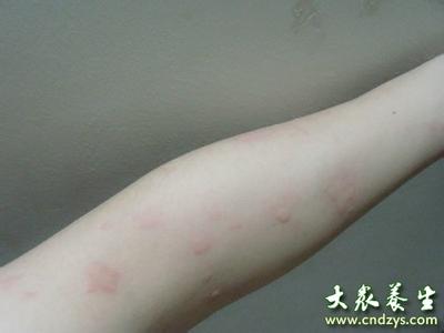风疹怎样不传染给别人 风疹传染吗