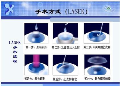 lasek手术 LASEK LASEK-基本介绍，LASEK-手术优点