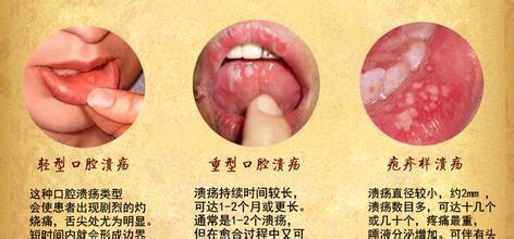 口腔溃疡快速治疗法 口腔溃疡的治疗方法 8种疗法根除口腔溃疡
