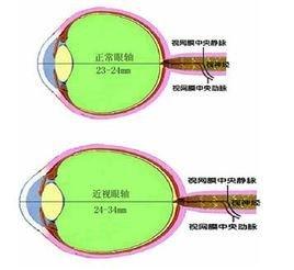 近视眼是什么原因 近视眼的原因 近视眼的危险因素是什么