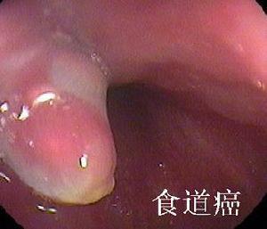 食道癌的早期症状 食道癌的症状 怎样判断是否得了食道癌