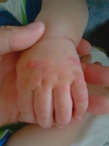 手足口病症状图片 小孩手足口病症状