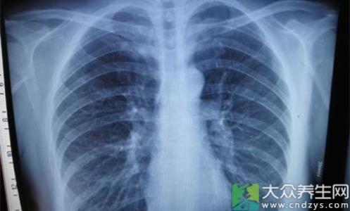 肺部小结节如何治疗 肺部结节 肺部结节是如何引起的