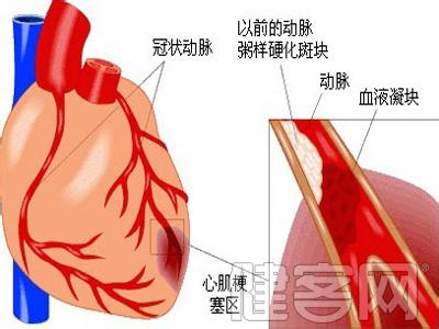 亚急性心肌梗塞定义 心肌梗塞 心肌梗塞-概述，心肌梗塞-定义