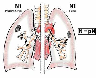 小细胞肺癌晚期症状 小细胞肺癌 小细胞肺癌有哪些症状