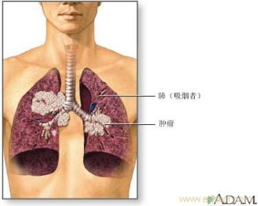 肺癌晚期症状 肺癌晚期症状 肺癌晚期能治好吗
