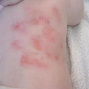 慢性阴囊湿疹症状 慢性湿疹的症状 9种慢性湿疹的常见症状