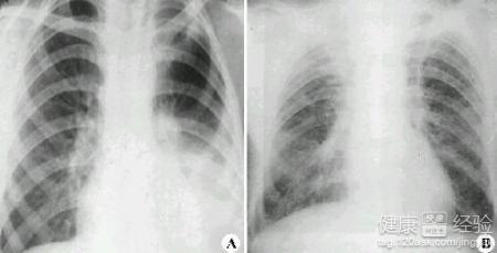 间质性肺炎什么症状 什么是间质性肺炎 间质性肺炎有哪些症状