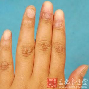 指甲横纹看健康图解 指甲上有横纹 指甲揭露你的健康状况