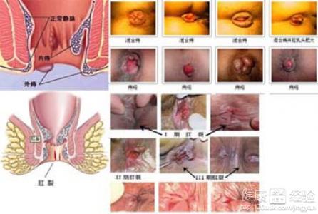 产后痔疮可以用马应龙 产后痔疮怎么办