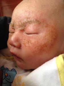 宝宝湿疹最佳治疗方法 宝宝湿疹是怎么引起的