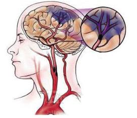 缺血性脑卒中病因 缺血性脑卒中 缺血性脑卒中-病因，缺血性脑卒中-症状