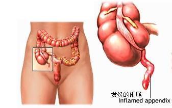 慢性阑尾炎有什么症状 慢性阑尾炎的症状 慢性阑尾炎有什么症状