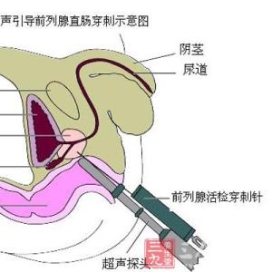 前列腺癌内分泌治疗 前列腺癌的治疗 带你正确认识前列腺癌