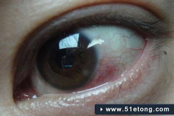 眼角膜发炎 眼角膜炎 眼角膜炎如何护理