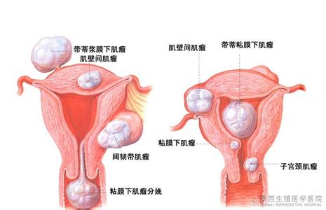 宫颈癌的早期症状 子宫肌瘤症状