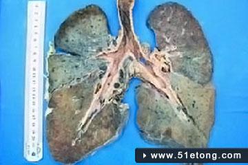 尘肺病能活多久 尘肺病的症状是什么