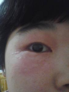 肾炎的早期症状 眼睛肿是什么原因