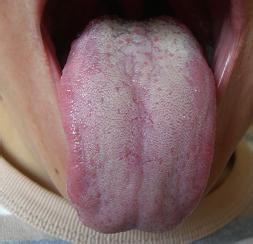 舌苔厚白吃什么食物 舌苔厚白怎样治疗