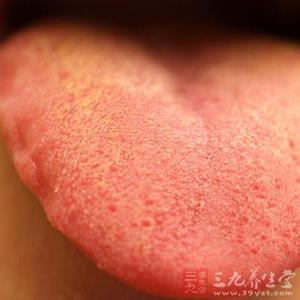 舌苔发黄是什么原因 舌苔发黄是什么原因 舌苔发黄有什么解决方法