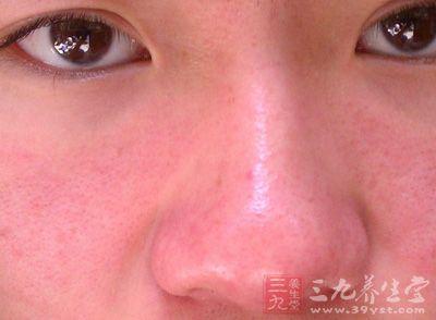 脸上皮肤过敏红肿痒 脸上过敏红肿怎么办 脸上过敏红肿如何防治