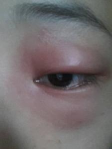哭后眼睛肿的危害 眼睛哭肿了怎么快速消肿？