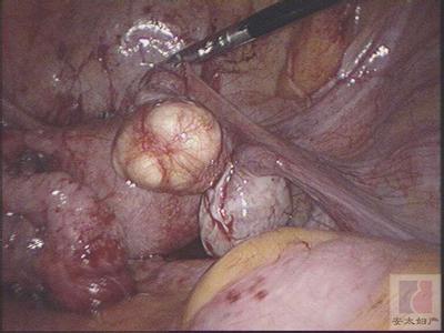 子宫内膜结核的症状 子宫内膜结核 子宫内膜结核有哪些症状