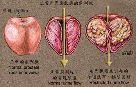 细菌性前列腺炎症状 细菌性前列腺炎症状 什么是细菌性前列腺