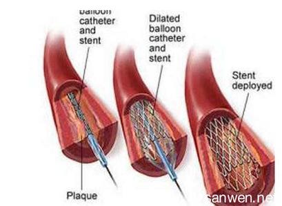 心肌梗塞的原因 心肌梗塞的原因 这6个“导火索”诱发心肌梗塞