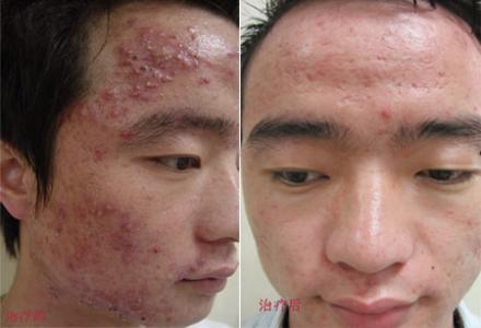 如何治疗脸上青春痘 痤疮青春痘的最佳治疗方法