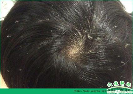 头皮屑多痒是什么原因 头皮屑多是什么原因？头皮屑多又痒怎么办？