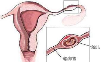 输卵管粘连症状 输卵管粘连 输卵管粘连-原因，输卵管粘连-症状