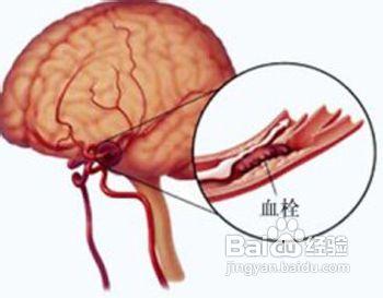 脑血栓饮食注意事项 脑血栓要注意什么 脑血栓的饮食禁忌