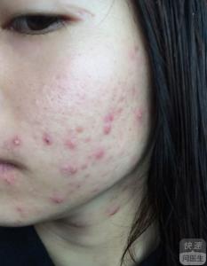 治疗脸上痤疮的好方法 脸上痤疮的治疗方法 如何治疗脸上痤疮