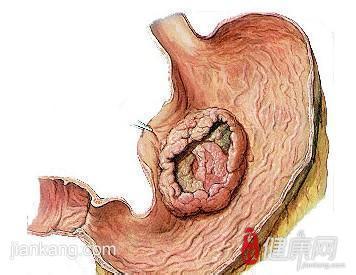 胃癌术后并发症 胃癌术后并发症 胃癌术后的迹象