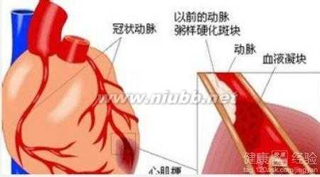 心肌缺血如何防治 心肌缺血怎么办 如何有效防治心肌缺血