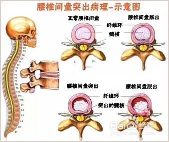 腰椎间盘突出症的原因 腰椎间盘突出引发的原因是什么