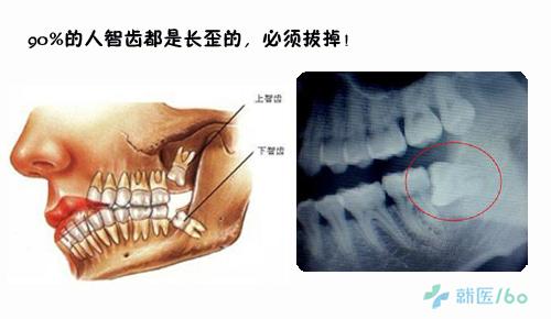 智齿不拔会怎么样 智齿是什么 长智齿拔还是不拔