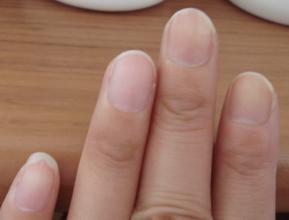 灰指甲图片 灰指甲的初期症状图