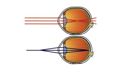 近视眼预防措施 近视眼 近视眼-概述，近视眼-治疗措施
