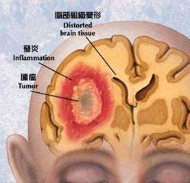 脑膜炎患者的护理 脑膜炎严重吗 脑膜炎患者护理要注意什么